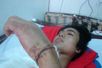 Nối thành công bàn tay trái bị đứt lìa