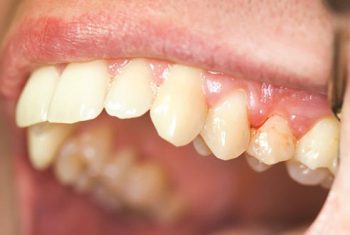 Bệnh viêm nha chu: Coi chừng rụng răng