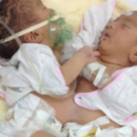 Đôi song sinh Hà Giang chào đời dính liền ngực và bụng