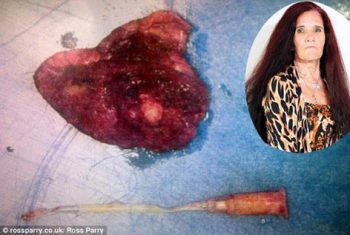 Bác sĩ để quên ống nhựa trong cơ thể bệnh nhân