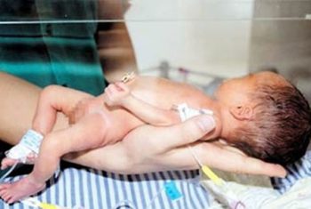 Bé bị gãy tay, chân khi mổ sinh: Do bé bị xương thủy tinh?