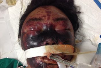 Thêm 3 Nạn nhân ăn tiến canh lợn