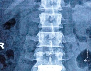 Người đầu tiên thay đĩa đệm nhân tạo tại Việt Nam: Giã từ cơn đau