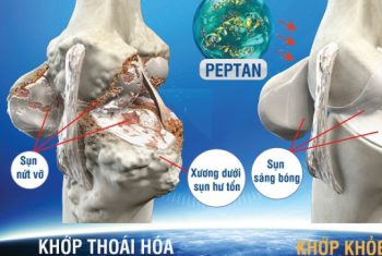 Giải pháp khoa học mới giúp chăm sóc khớp toàn diện
