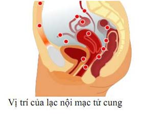 Lạc nội mạc tử cung
