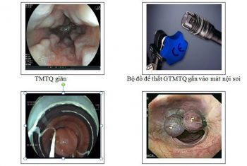 Điều trị dự phòng xuất huyết tiêu hóa do giãn vỡ tĩnh mạch thực quản bằng thắt vòng cao su qua nội soi tiêu hóa.