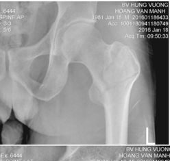 Điều trị phẫu thuật gãy liên mấu chuyển xương đùi  ở Bệnh viện Hùng Vương