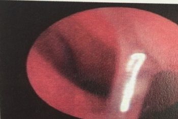Vĩnh Phúc: Bé 3 tuổi đi ăn cỗ bị đũa đâm xuyên mũi nguy kịch