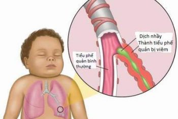 Nhiễm khuẩn hô hấp cấp tính