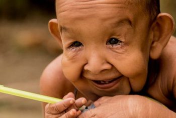 ​Mắc bệnh hiếm gặp, bé 4 tuổi nhìn như ông già 80