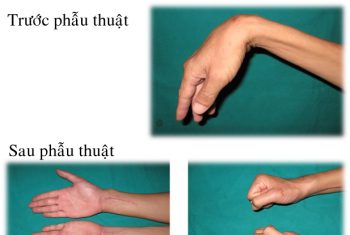 Điều trị di chứng liệt thần kinh ở chi trên bằng phẫu thuật tạo hình – chuyển gân