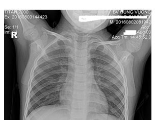 Ẩm ướt, coi chừng bệnh nấm phổi