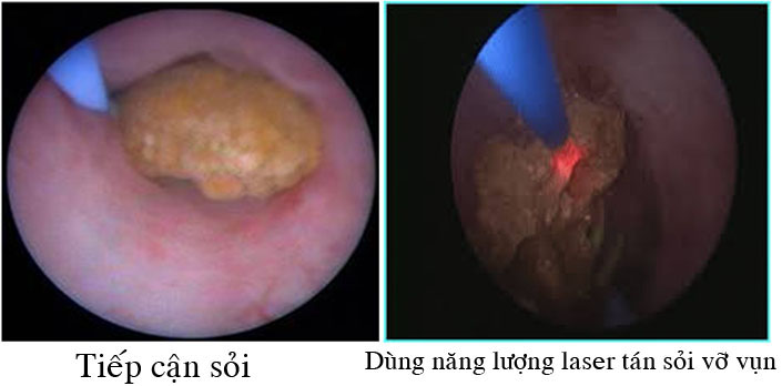 soi nieu quan