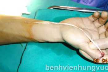 BVHV Nối gân thành công cho bệnh nhân có vết thương phức tạp bàn tay.