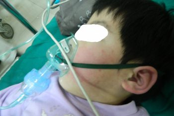 Cấp cứu kịp thời bé 5 tuổi sốc phản vệ hết sức nguy kịch