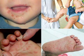 Bệnh Tay – Chân – Miệng: Nhận biết và xử trí