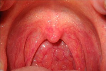 Phân tích tổng hợp: Corticoisteroid làm giảm triệu chứng đau ở bệnh nhân đau họng cấp