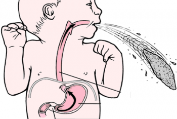 Bệnh hẹp phì đại môn vị ở trẻ sơ sinh