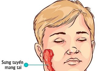 Có 4 bài thuốc này trong tay thì không sợ bệnh quai bị