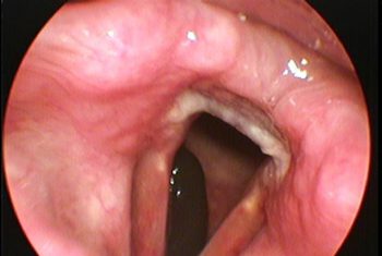 BVĐK Hùng Vương gắp con vắt gần 5 cm sống trong khí quản bệnh nhân