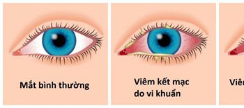 Bệnh viêm kết mạc cấp