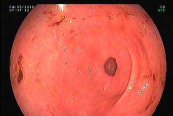 Một chú rể phải vào viện cấp cứu trước giờ đón dâu vài giờ vì uống nhiều rượu