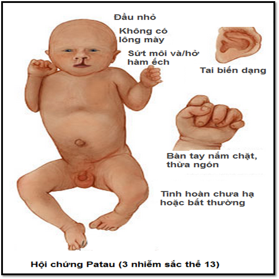 hinh hoi chung patau (NST 13)