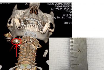 Phẫu thuật lấy dị vật xương hàm bé 6 tuổi bị thương do đồ chơi tự chế