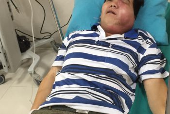 Biến dạng khuôn mặt vì ổ áp xe.