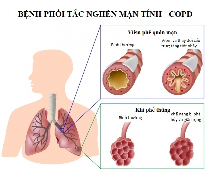 benh phoi tac nghen man tinh 3