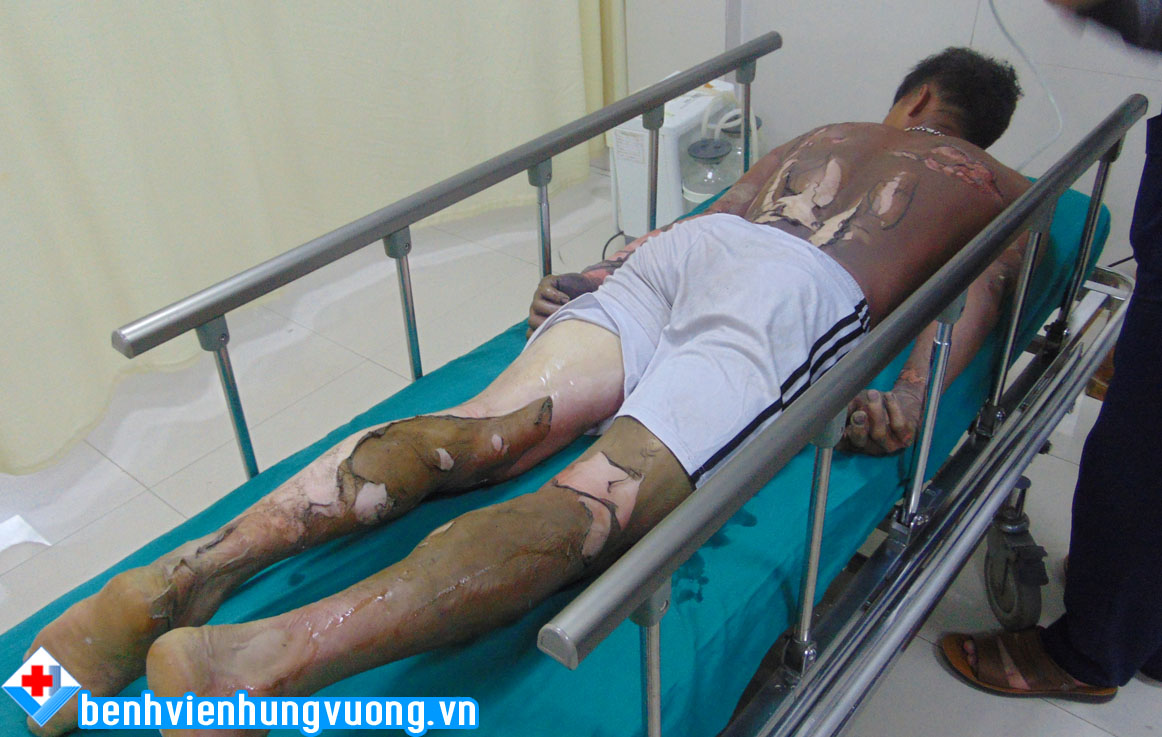 bong xang 1