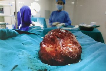 Phẫu thuật thành công bướu giáp khổng lồ cho bệnh nhân 63 tuổi.