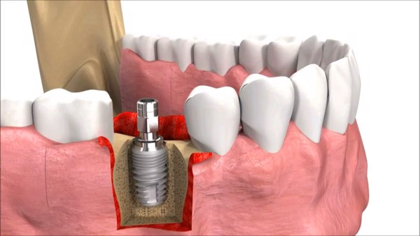 implant 29 grande