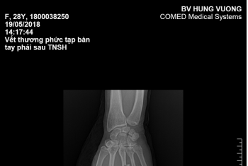 Gãy xương phức tạp bàn tay phải do máy ép gỗ.