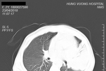 Báo động tình trạng kháng thuốc kháng sinh ở trẻ em.