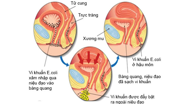 vi khuẩn e coli