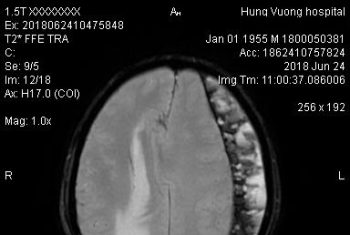 Phẫu thuật chấn thương sọ não cho bệnh nhân 63 tuổi sau ngã xe máy gần 1 tháng.