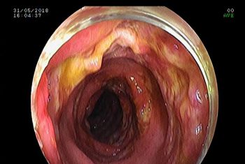 Bệnh nhân 29 tuổi nhiễm trùng máu do viêm ruột nặng.