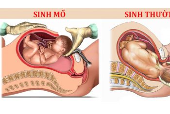 Sinh thường hay sinh mổ?