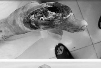 Rùng mình hình ảnh bàn chân "mục ruỗng" của bệnh nhân đái tháo đường