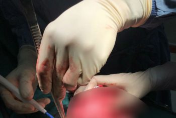 Cắt bán phần tử cung do khối u kích thước lớn.