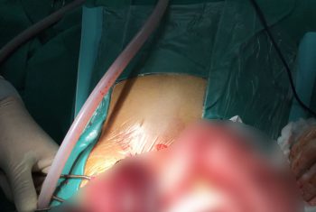 Hoại tử 1m ruột sau 2 ngày không đi đại tiện.