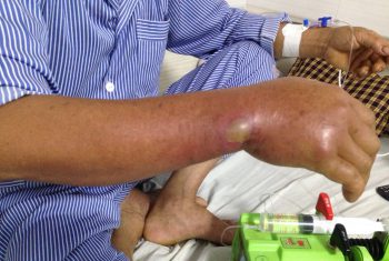 Cổ tay lên mụn mủ, sưng phù sau khi đi cắt cỏ cho cá.