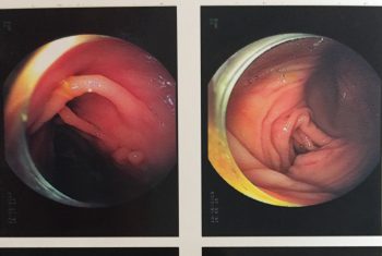 Polyp “chằng chịt” trong đại tràng bệnh nhân 29 tuổi.