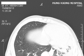 Bệnh nhi viêm phổi nặng do Mycoplasma.