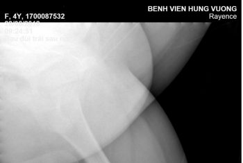 Bé gái 4 tuổi gãy 1/3 xương đùi trái khi chơi ở sân giếng.