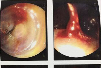 Nôn ra máu tươi do vỡ tĩnh mạch thực quản.  