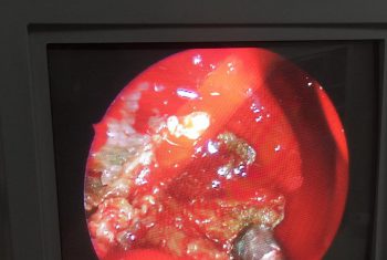 Nấm xoang hàm: bệnh nguy hiểm, khó phát hiện