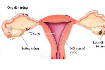 Lạc nội mạc tử cung: những vấn đề liên quan.