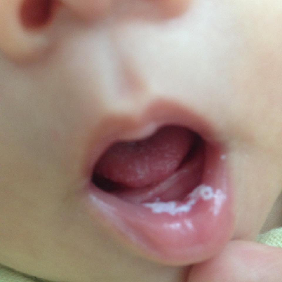 Những điều cha mẹ cần biết về nấm miệng ở trẻ em. - Bệnh Viện Đa ...